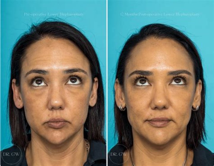 Did Jaime Pressly Get a Forehead Lift?! Our Plastic Surgery Experts Weigh In!