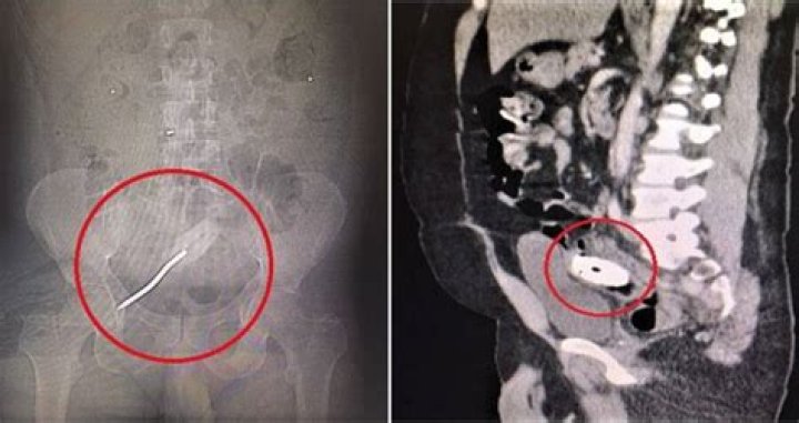 Florida Man Undergoes Surgery To Remove Screwdriver From His Rectum