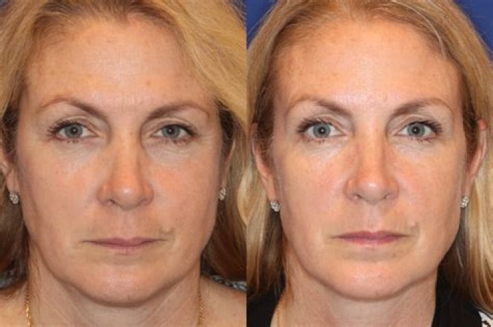 NYC’s Facelift Expert Dr. Jennifer Levine Shares Trending Facial Treatments for 2023